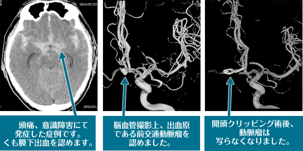 茨城 土浦市 脳神経外科 くも膜下出血 おおくぼ脳脊椎クリニック