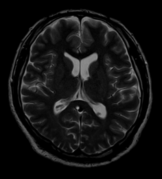 頭部MRI T2)