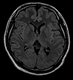 頭部MRIフレアー