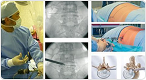 腰椎椎間板ヘルニアに対する経皮的内視鏡手術(PELD)